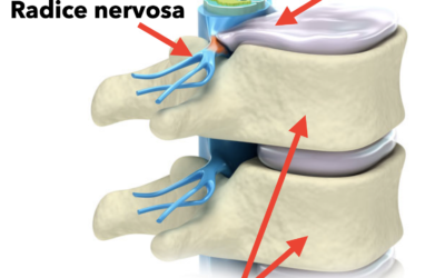 Ernia discale: terapia medica o chirurgia ?